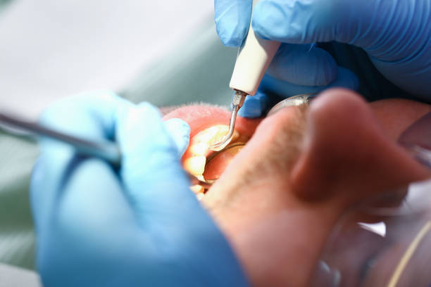 Best Emergency Root Canal Therapy in Mayo, MD